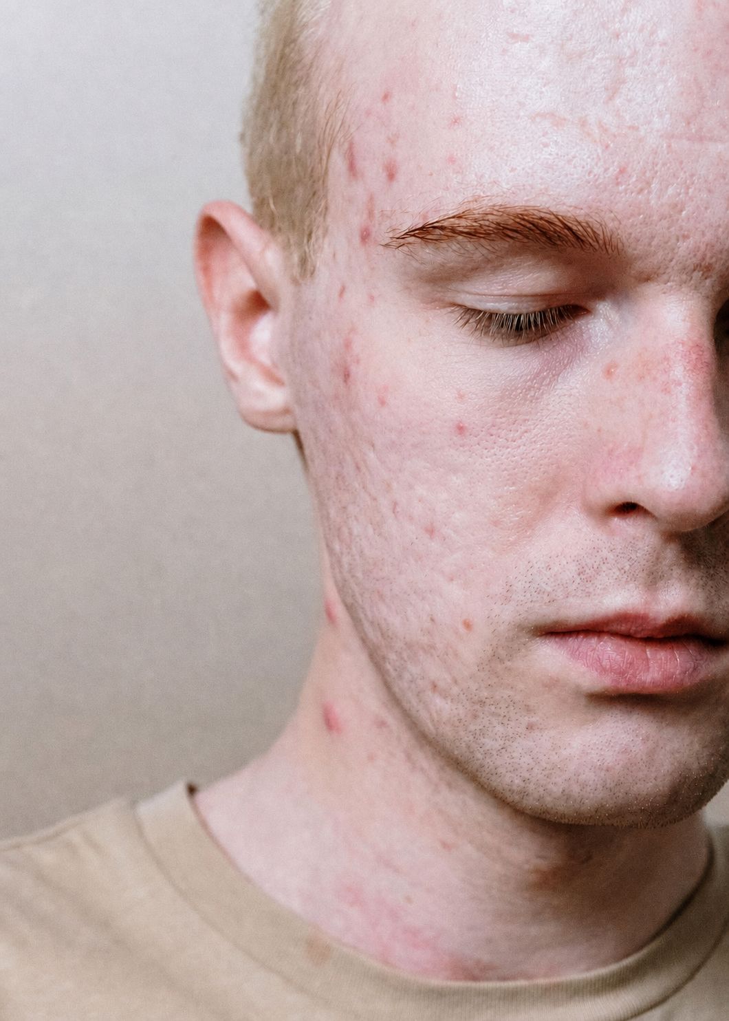Acne and breakout treatment at Rejuvia Wellness
