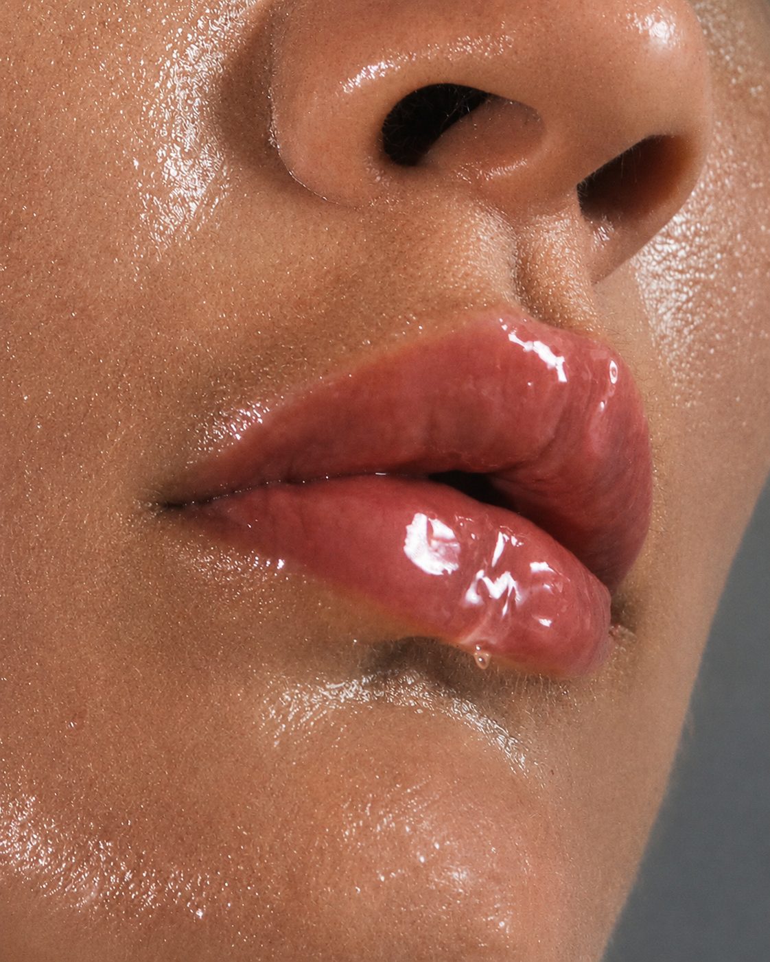 Dermal filler results — glossy, natural volume
