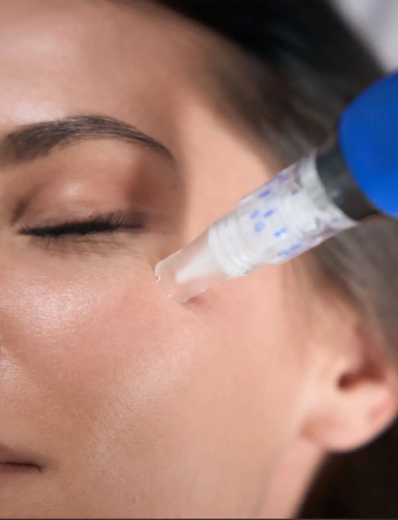 Microneedling in progress at Rejuvia
