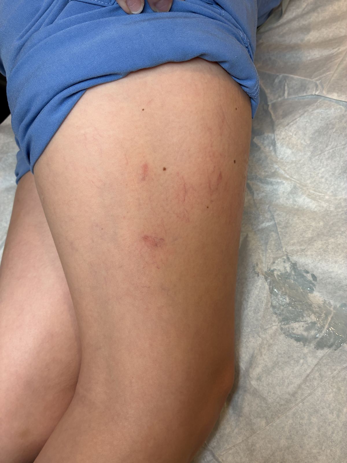 A leg vein treatment session at Rejuvia