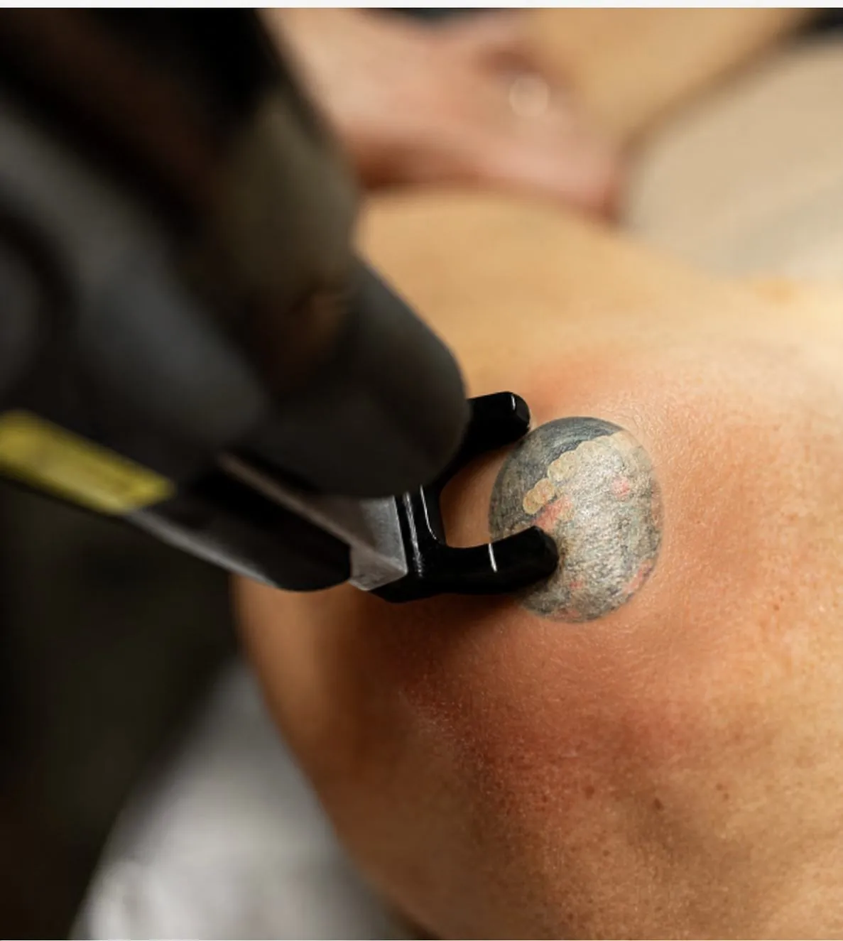 Tattoo Removal — the PicoLO breaking up ink at Rejuvia
