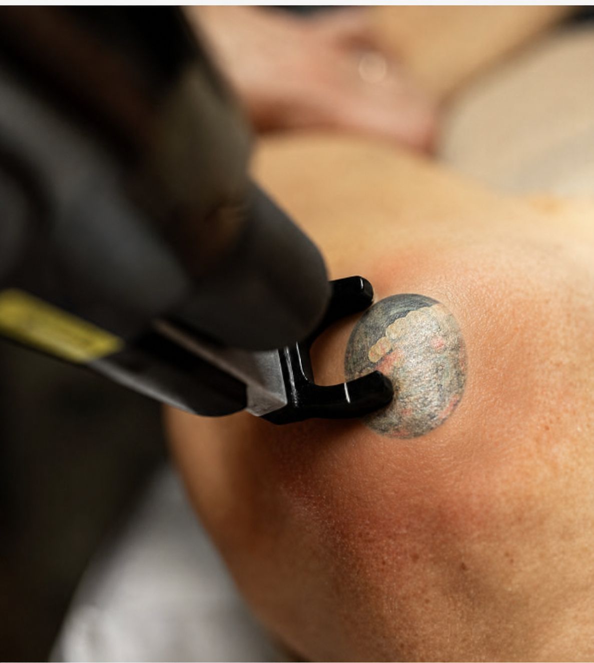 A tattoo mid-removal — fading over a package of sessions